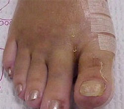 bunions after