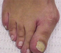 bunions before